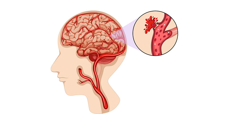 Best Clinic for Brain Hemorrhage in India