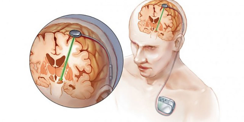 Best Deep brain Stimulation Treatment in India