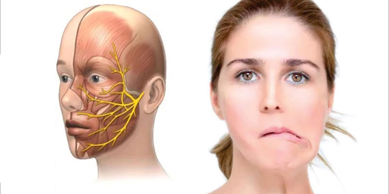 Bell's Palsy doctor in Gurgaon