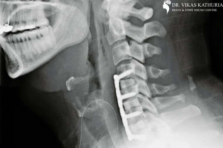 Cervical Spine Treatment in India