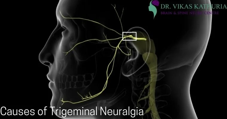What is the main cause of Trigeminal Neuralgia