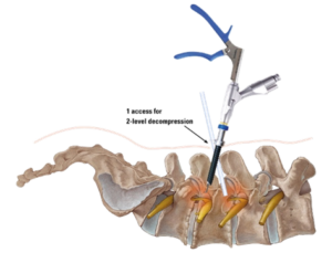 Endoscopic Spine Surgery in Gurgaon, Delhi – India