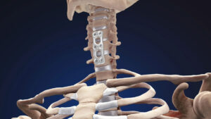 ACDF Surgery in Gurgaon – Delhi